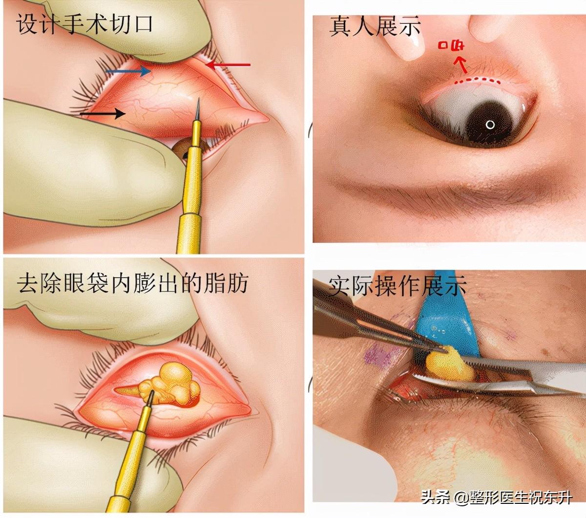 最新祛眼袋步骤指南，打造迷人眼部轮廓