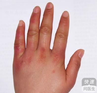 蛇泡疮最新治疗方法，启程励志之旅，自信成就变化之路